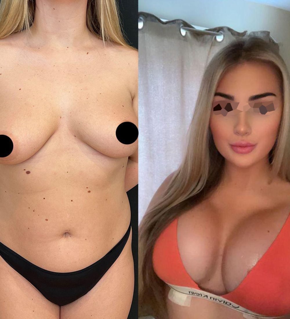 breast-surgery-turkey