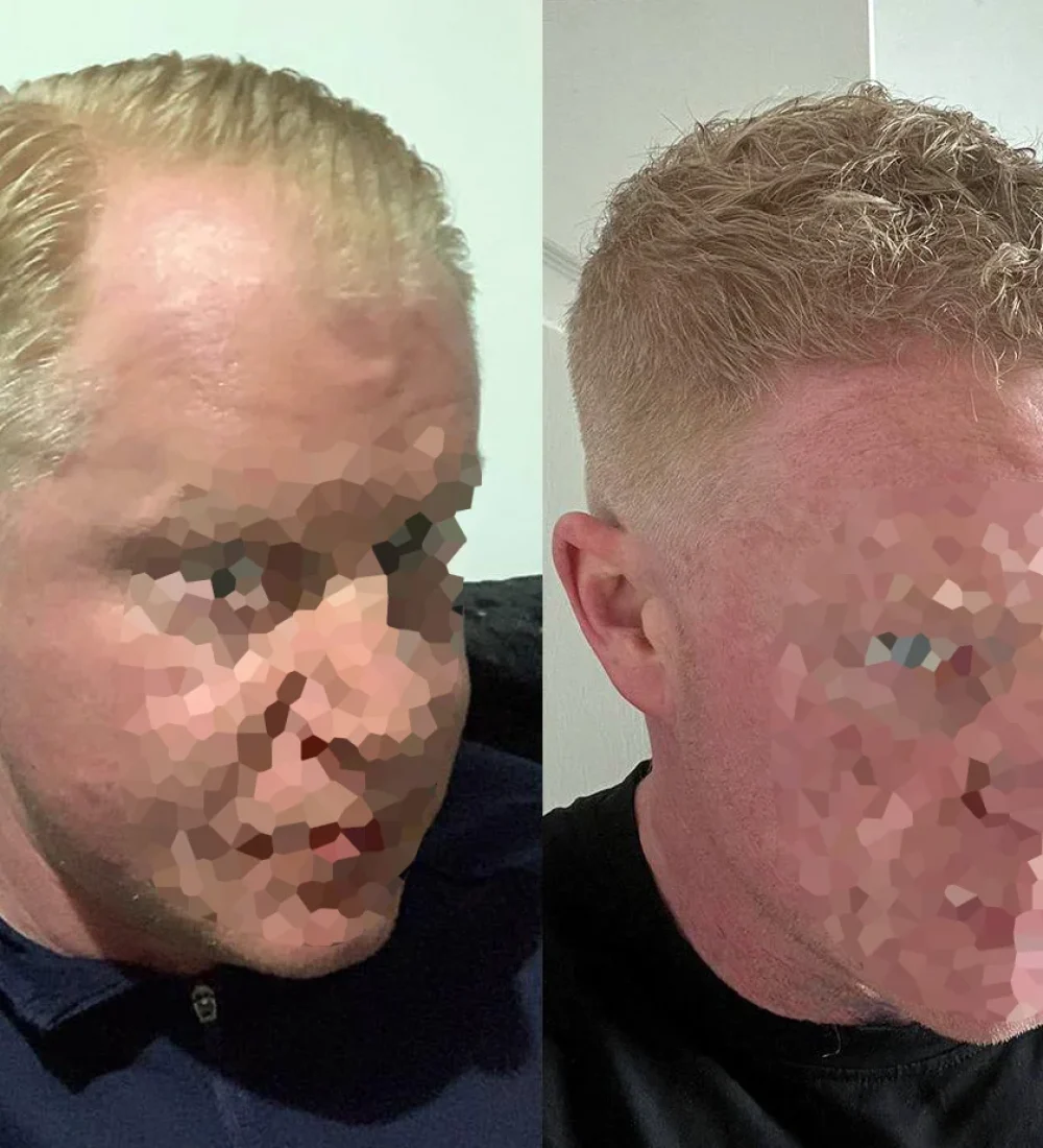 hair-transplant-2