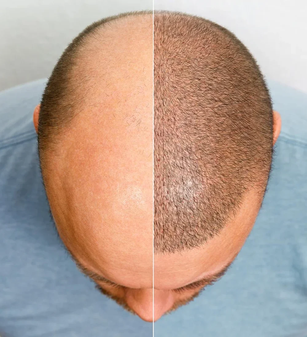hair-transplant-turkey